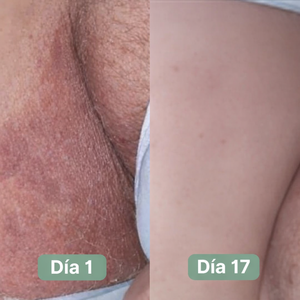 DermaPure Jabón Antihongos