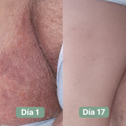 DermaPure Jabón Antihongos